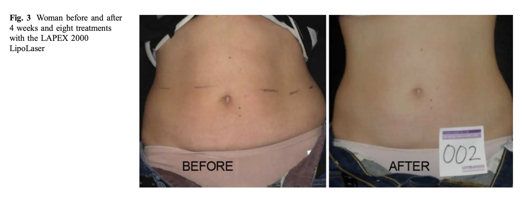 Before and after photos showing red light therapy fat reduction results