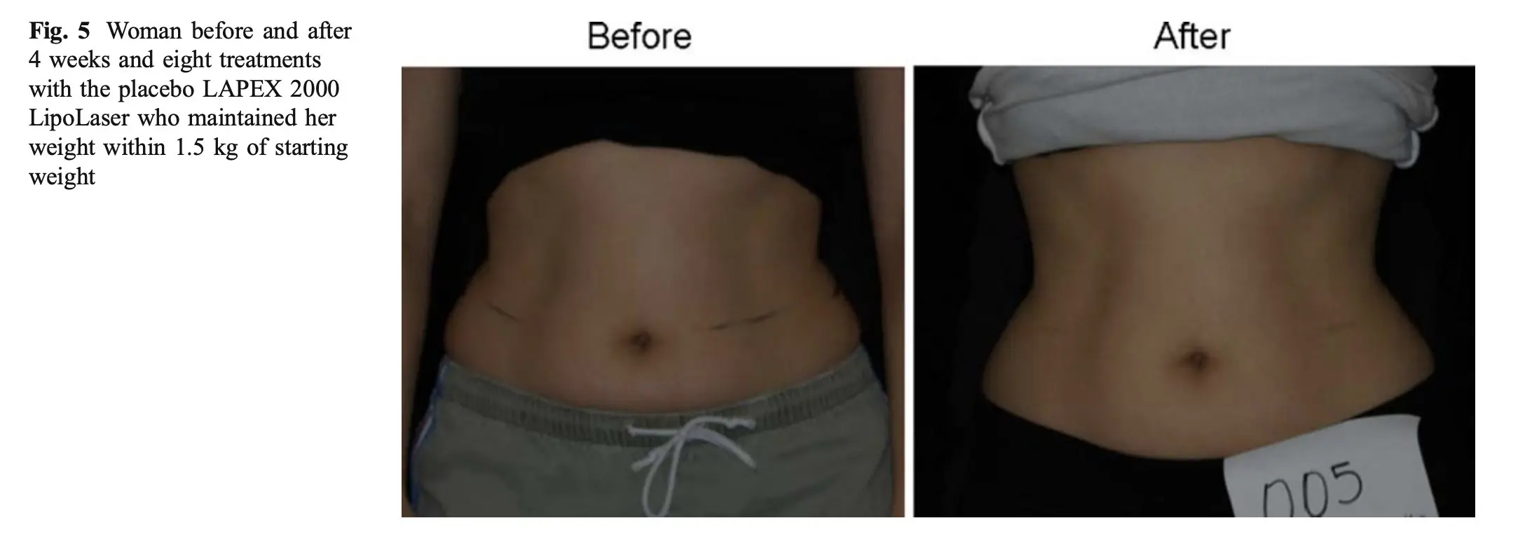 Additional before and after visual showing red light therapy body contouring