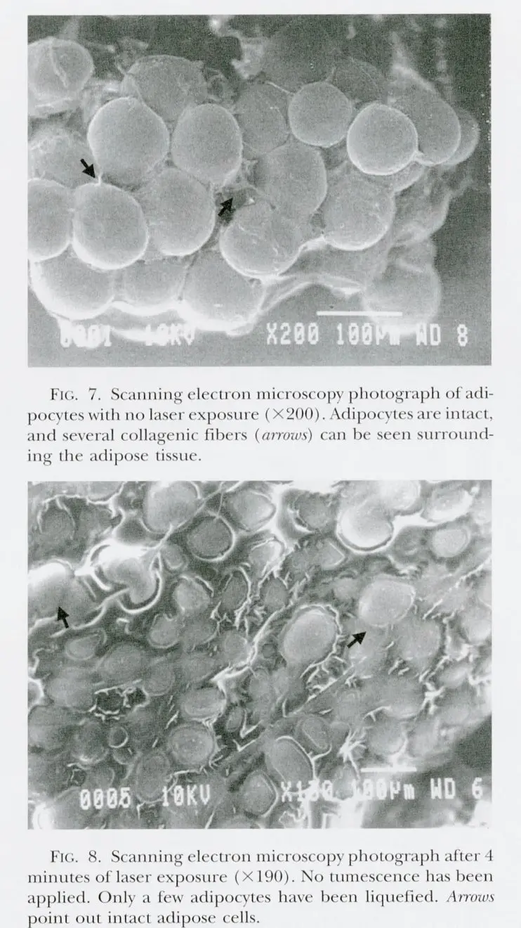 Scanning electron microscopy showing fat cell liquefaction after laser exposure