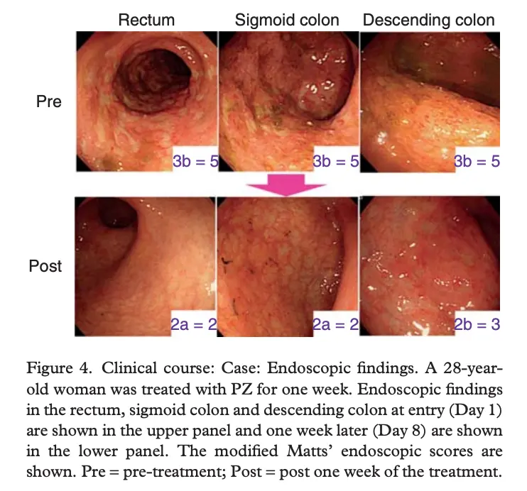 Endoscopic images showing before and after zinc carnosine treatment - visible remission of ulcers and inflammation in colonic tissue within one week of treatment