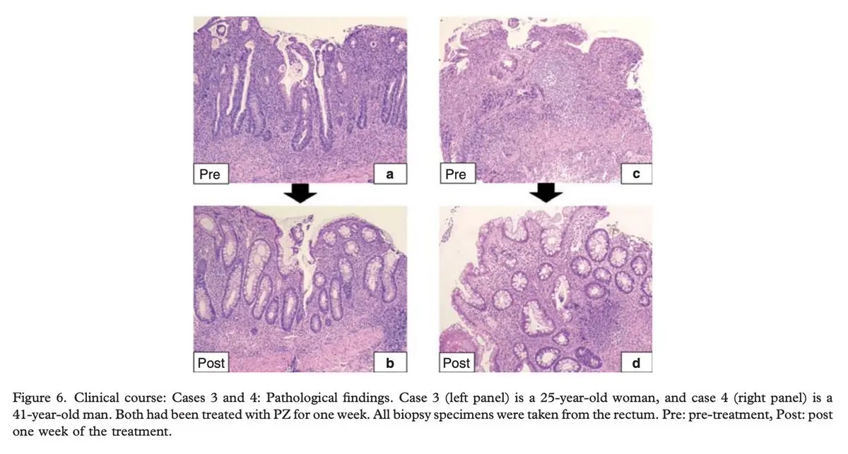 Histological microscopy comparing gut tissue before and after zinc carnosine treatment - pre-treatment shows dense inflammatory infiltrate, distorted crypts and reduced goblet cells; post-treatment shows restored crypt architecture, replenished goblet cells and reduced inflammation